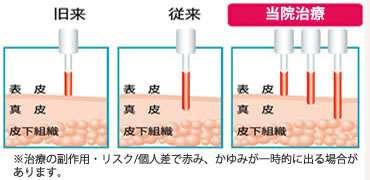 小岩 ヒフ科,精美スキンケアクリニックのトリプルレイヤー法